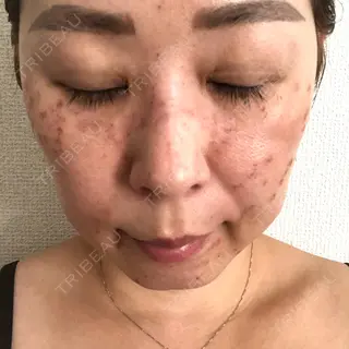 3日目の経過画像（1枚目）