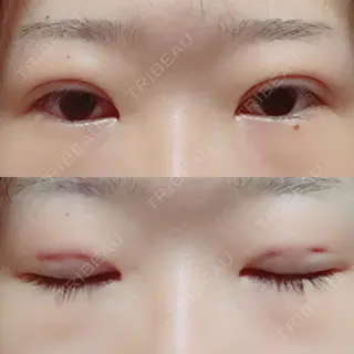 0日目の経過画像（1枚目）