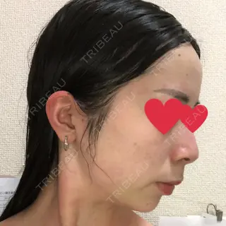 4日目の経過画像（2枚目）