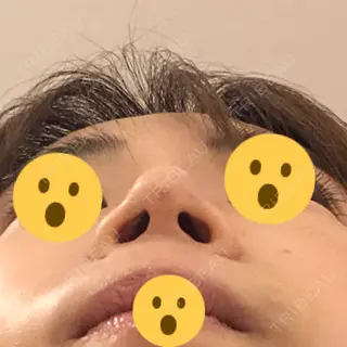 5日目の経過画像（1枚目）