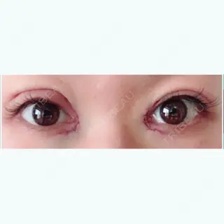 0日目の経過画像（1枚目）