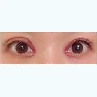 2日目の経過画像（1枚目）