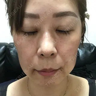 5日目の経過画像（1枚目）