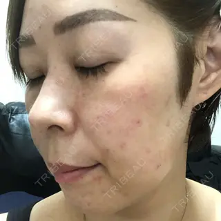 5日目の経過画像（2枚目）
