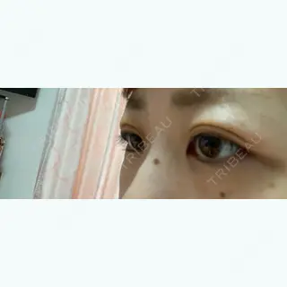 3日目の経過画像（3枚目）