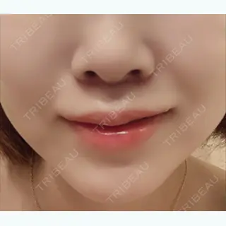 6日目の経過画像（1枚目）