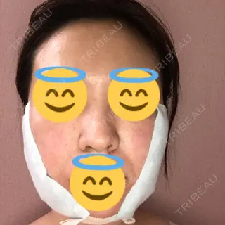 0日目の経過画像（1枚目）