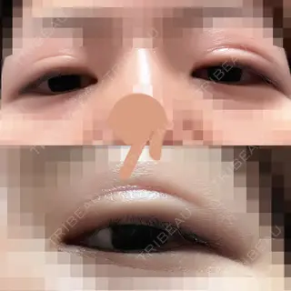 74日目の経過画像（2枚目）