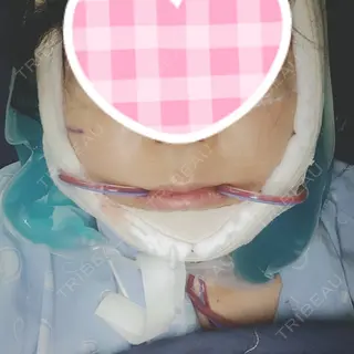 1日目の経過画像（1枚目）