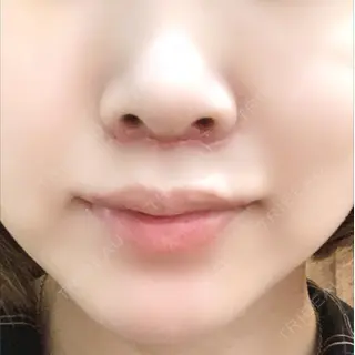 7日目の経過画像（1枚目）