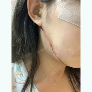 0日目の経過画像（3枚目）