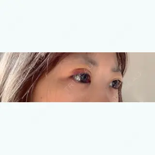 5日目の経過画像（3枚目）