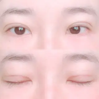 17日目の経過画像（1枚目）