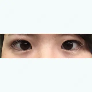 0日目の経過画像（1枚目）