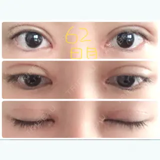 62日目の経過画像（1枚目）