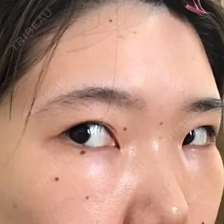 7日目の経過画像（2枚目）