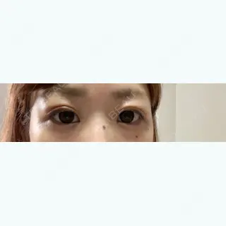 6日目の経過画像（1枚目）