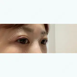 6日目の経過画像（3枚目）