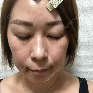 8日目の経過画像（1枚目）