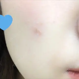 0日目の経過画像（2枚目）