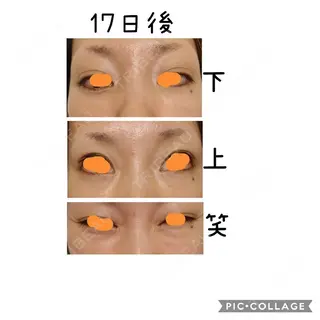 17日目の経過画像（1枚目）