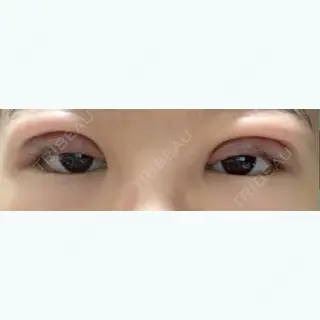 1日目の経過画像（1枚目）