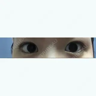 1日目の経過画像（1枚目）
