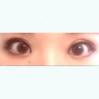 15日目の経過画像（1枚目）