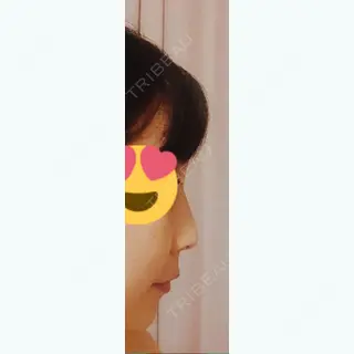 4日目の経過画像（1枚目）
