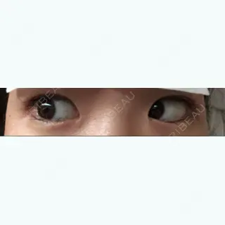 2日目の経過画像（1枚目）