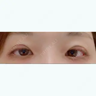 0日目の経過画像（1枚目）