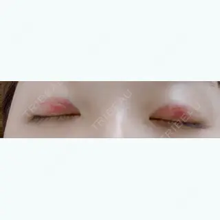 1日目の経過画像（2枚目）