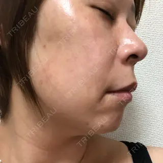 9日目の経過画像（3枚目）