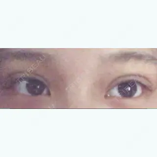 5日目の経過画像（1枚目）