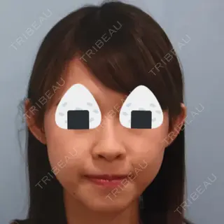 32日目の経過画像（1枚目）