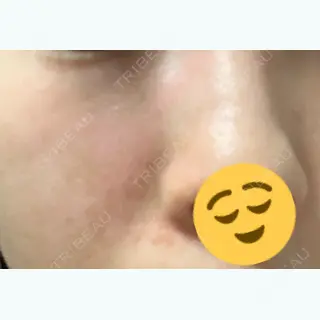 10日目の経過画像（1枚目）
