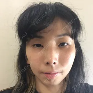21日目の経過画像（2枚目）
