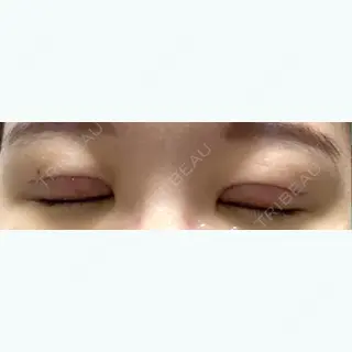 3日目の経過画像（2枚目）