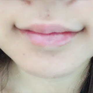 0日目の経過画像（3枚目）