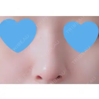 14日目の経過画像（1枚目）