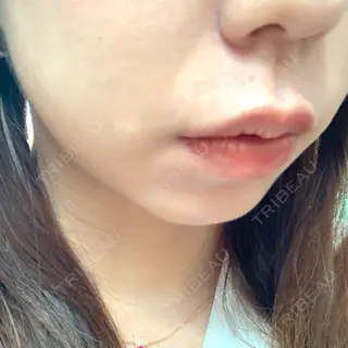 4日目の経過画像（2枚目）