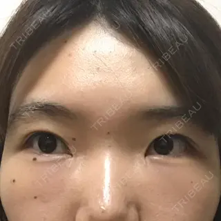 13日目の経過画像（1枚目）