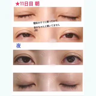 11日目の経過画像（1枚目）