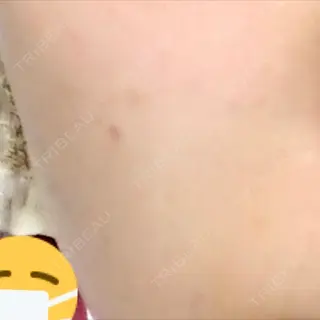5日目の経過画像（2枚目）