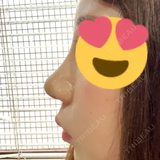 7日目の経過画像（2枚目）