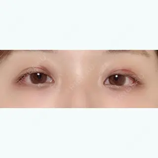 6日目の経過画像（1枚目）