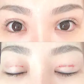 0日目の経過画像（2枚目）