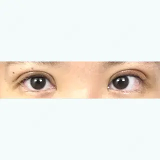 6日目の経過画像（1枚目）
