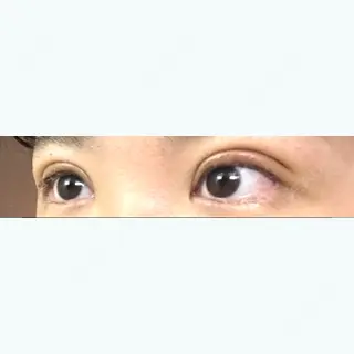 6日目の経過画像（3枚目）