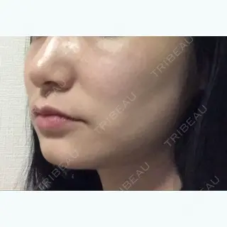 0日目の経過画像（3枚目）